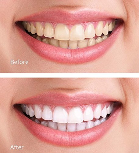 White Teeth Global 44% Carbamide Peroxide Teeth Whitening Gel Kit – 10 Syringes, 2 Trays, Shade Guide | At-Home Whitening