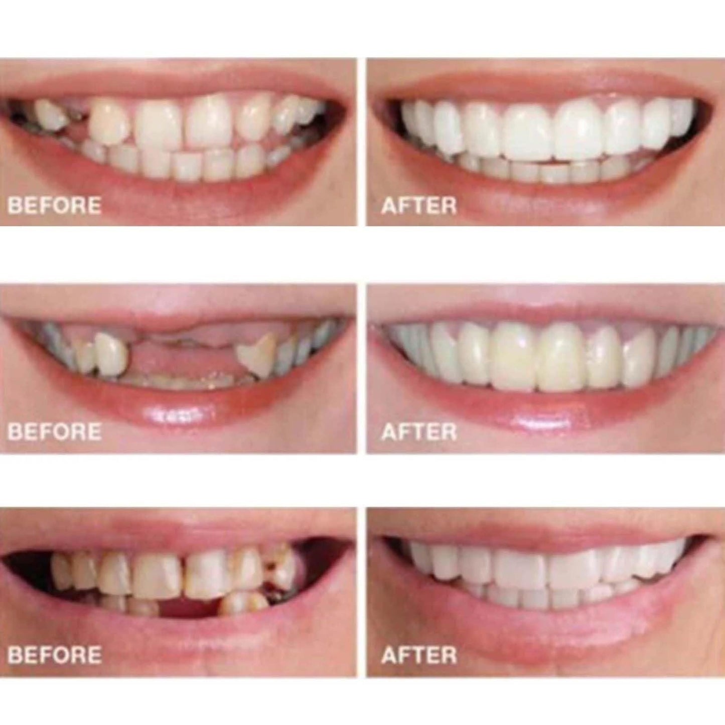 2 Pcs Temporary Adjustable Smile - Natural White, Comfortable for Men & Women