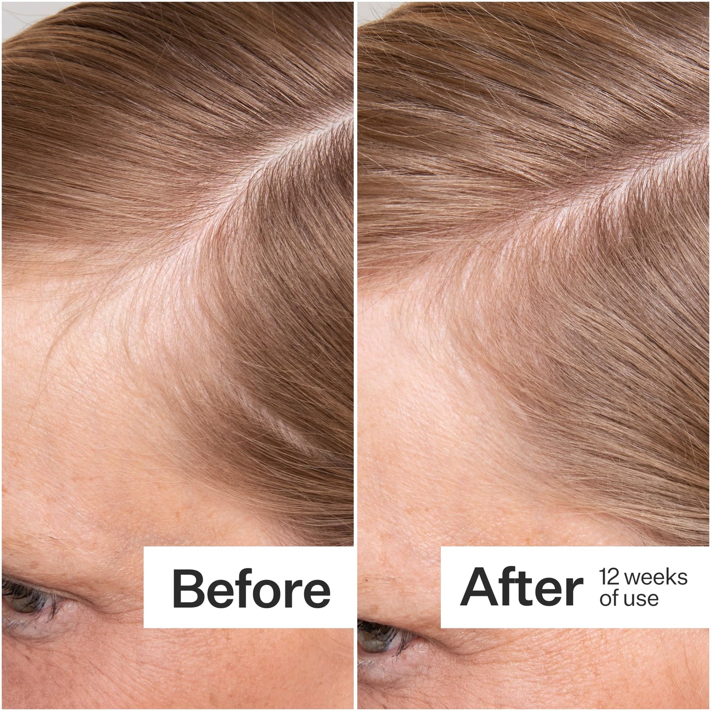 ACT+ ACRE Thick + Full Hair Capsules - Vegan Hair Support, 60ct