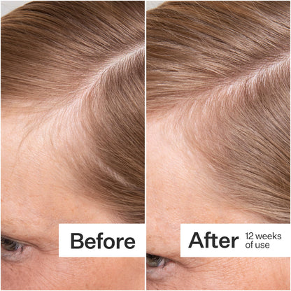 ACT+ ACRE Thick + Full Hair Capsules - Vegan Hair Support, 60ct