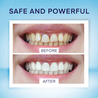 AsaVea Smile Teeth Whitening Pen - 4 Pens, 40+ Uses, No Sensitivity
