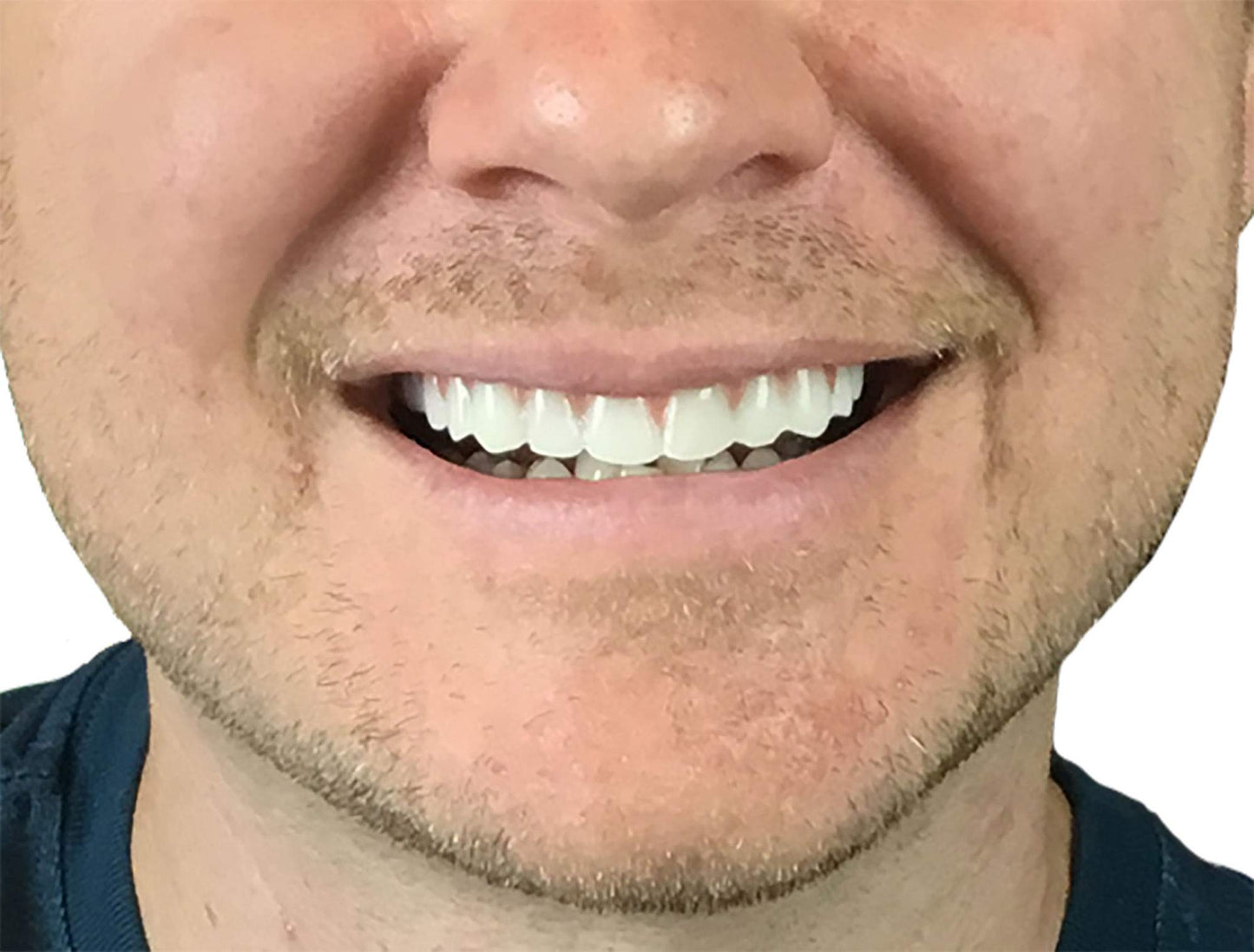 2 Pack Instant Smile Natural Shade Comfort Fit Flex Veneers – Fix Your Smile at Home in Minutes | Hand Crafted