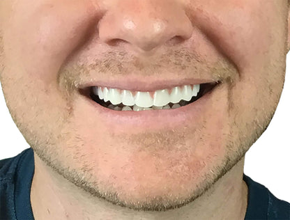 2 Pack Instant Smile Natural Shade Comfort Fit Flex Veneers – Fix Your Smile at Home in Minutes | Hand Crafted