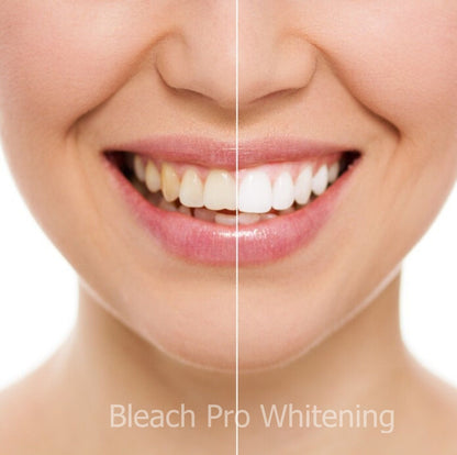 Teeth Whitening Gel Syringe Dispensers – 22% Carbamide Peroxide, 10 x 3ml Syringes