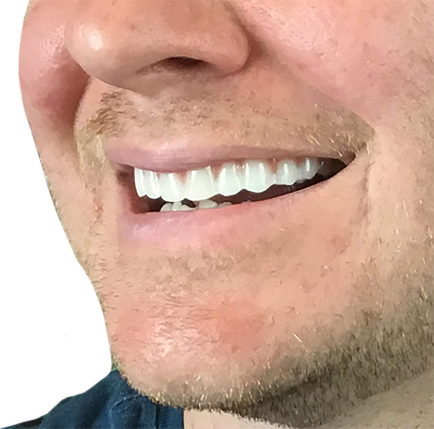 2 Pack Instant Smile Natural Shade Comfort Fit Flex Veneers – Fix Your Smile at Home in Minutes | Hand Crafted