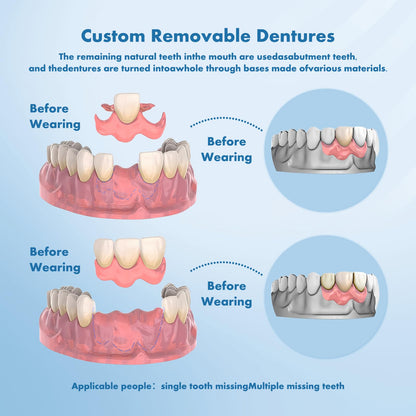 Custom Removable Dentures – Personalized Partial Denture Set | 1–6 Teeth