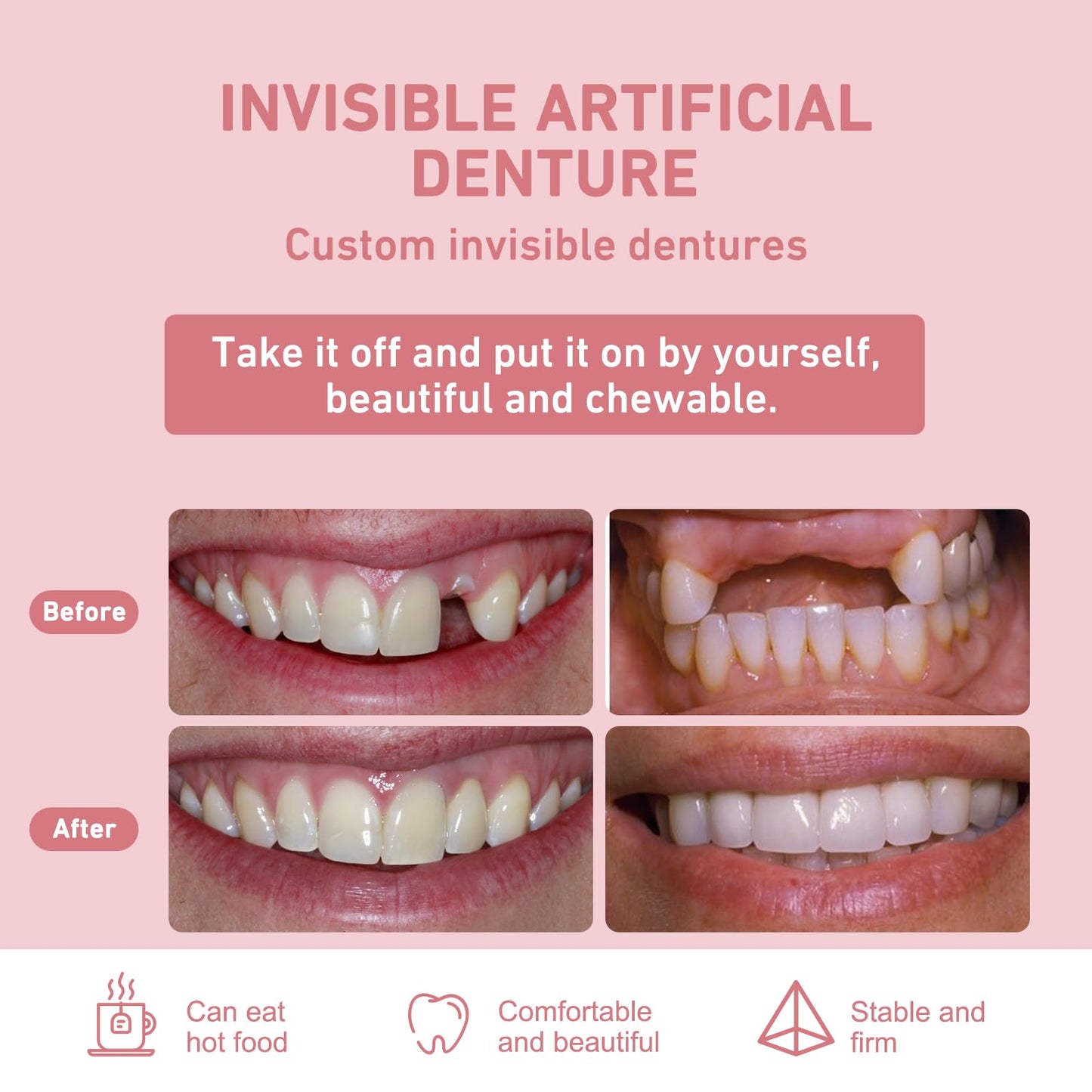 Custom Partial Dentures – Removable Denture Set for Missing Teeth (1-6) with Case | Natural Look & Comfortable Fit