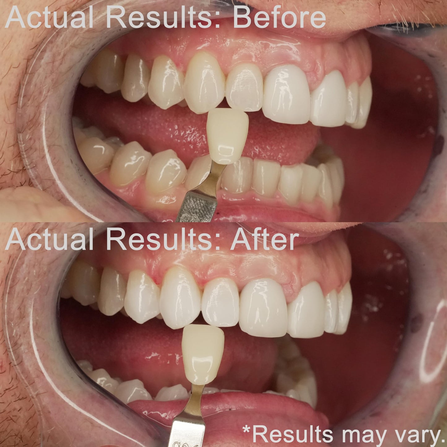 EZZI Teeth Whitening Kit - Fast 44% Carbamide Peroxide Whitening for Discolored Teeth and Intrinsic Stains