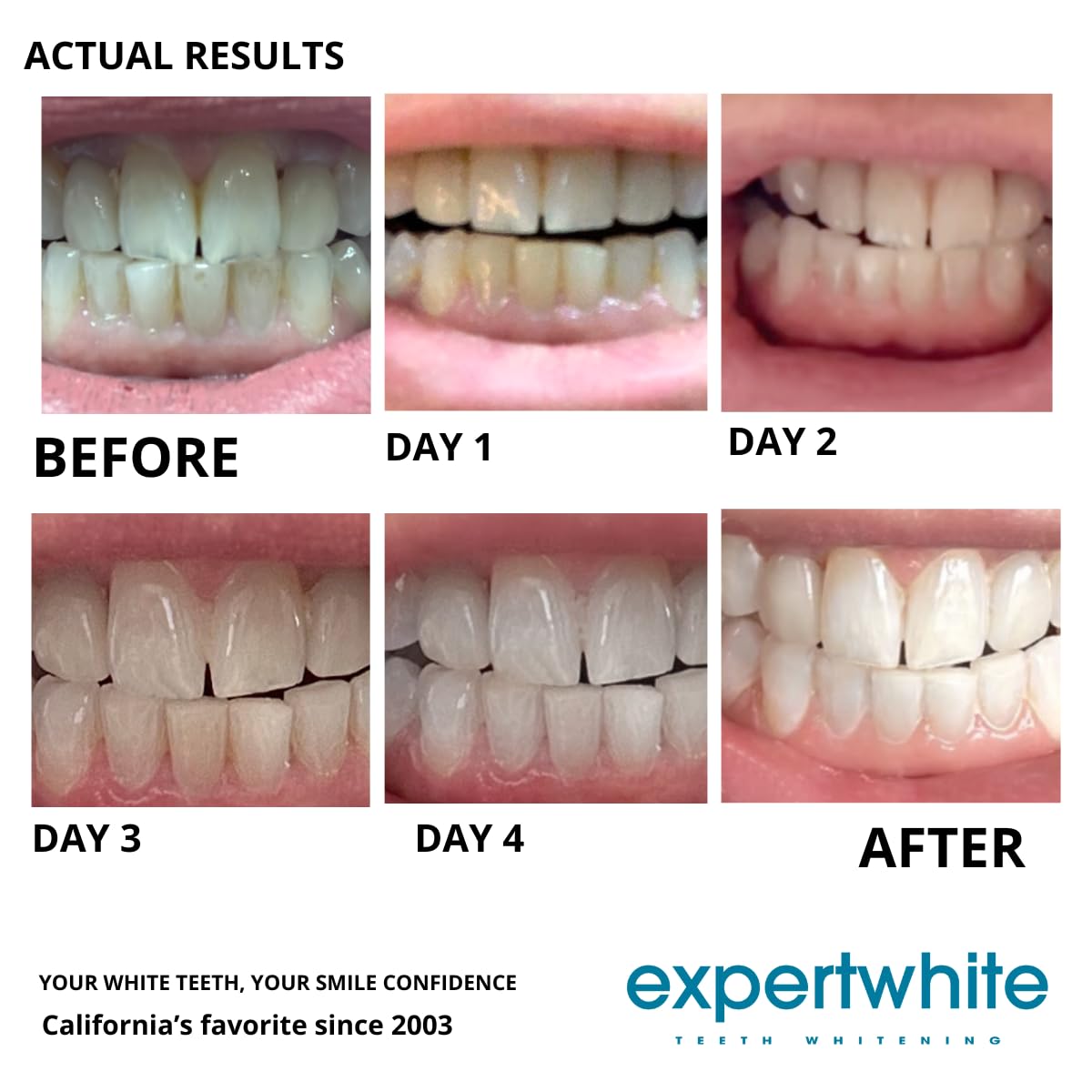 Expertwhite 22% Carbamide Peroxide Teeth Whitening Gel Refills – Made in USA