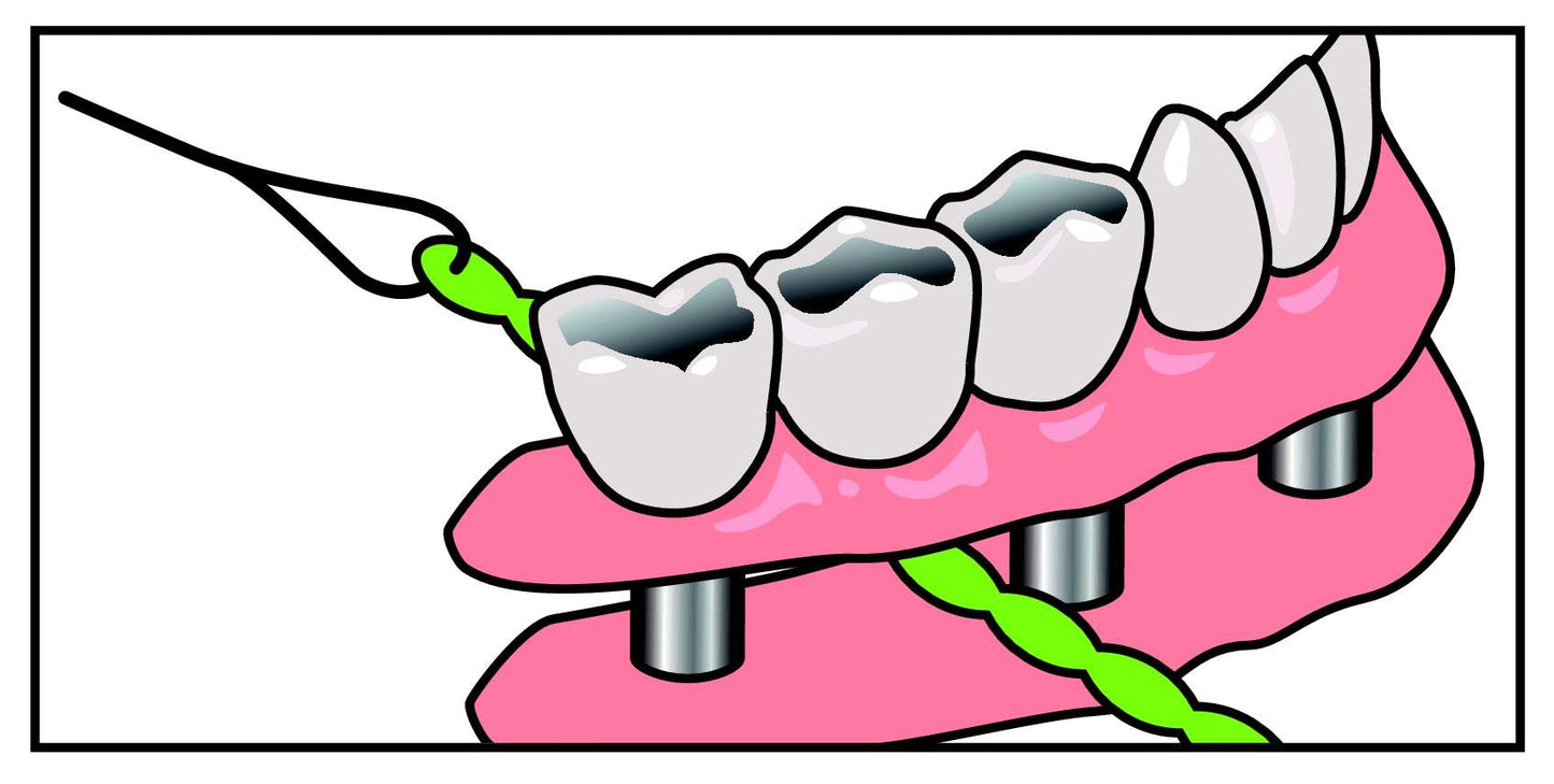 IDontix Brace X-Floss Green - Implants, Bridges & Braces