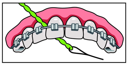 IDontix Brace X-Floss Green - Implants, Bridges & Braces