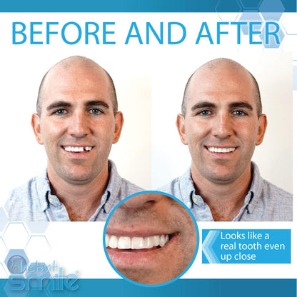 Instant Smile Temporary Tooth Replacement Kit - Replace a Missing Tooth Fast (Patented)