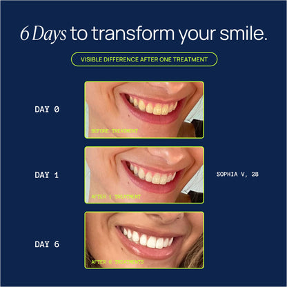 Laughland Super Strength Teeth Whitening Gel 3 Pack – 11% Hydrogen Peroxide, Mint, Glycerin & Aloe | At-Home Dental Care