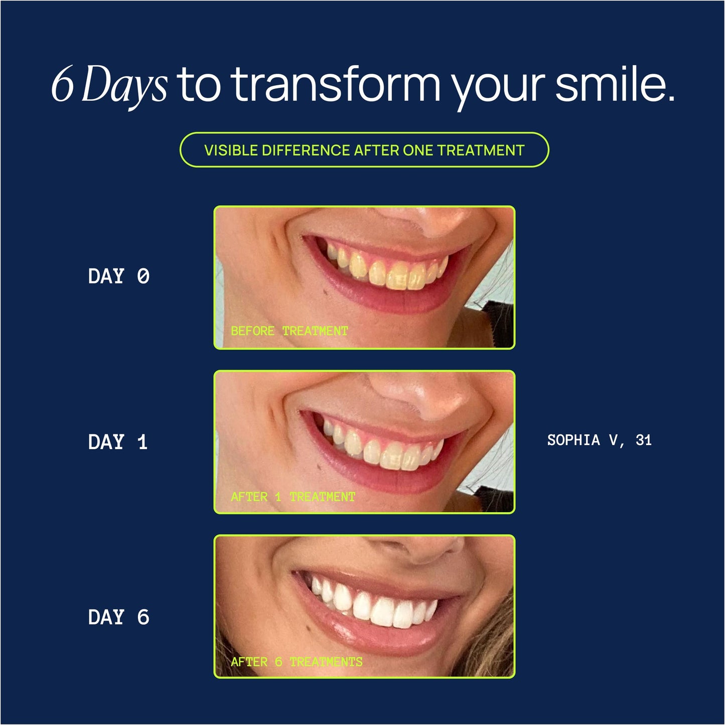 Laughland Gentle Teeth Whitening Kit - Phone-Powered LED Mouthpiece and 6+ Treatments