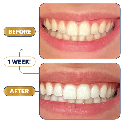 Lumineux Teeth Whitening Strips – 21 Treatments, Peroxide Free, Enamel Safe