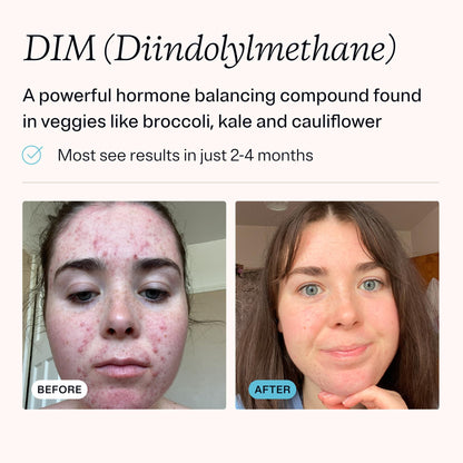 MDacne DIM Skin Clearing Supplements – 30 Vegan Capsules | Acne Treatment, Estrogen Balance & Hormone Support