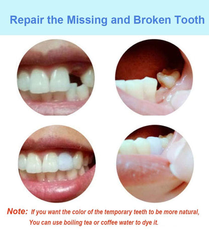 Tooth Filling Thermal Beads – DIY Moldable Temporary Teeth Repair Kit (2 Pack)