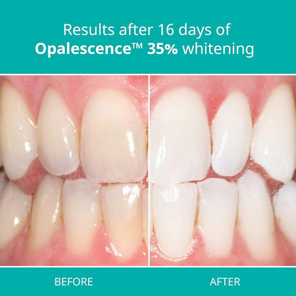 Opalescence 35% PF Whitening Refill Kit – 4 Syringes | Ultradent A-5197-2