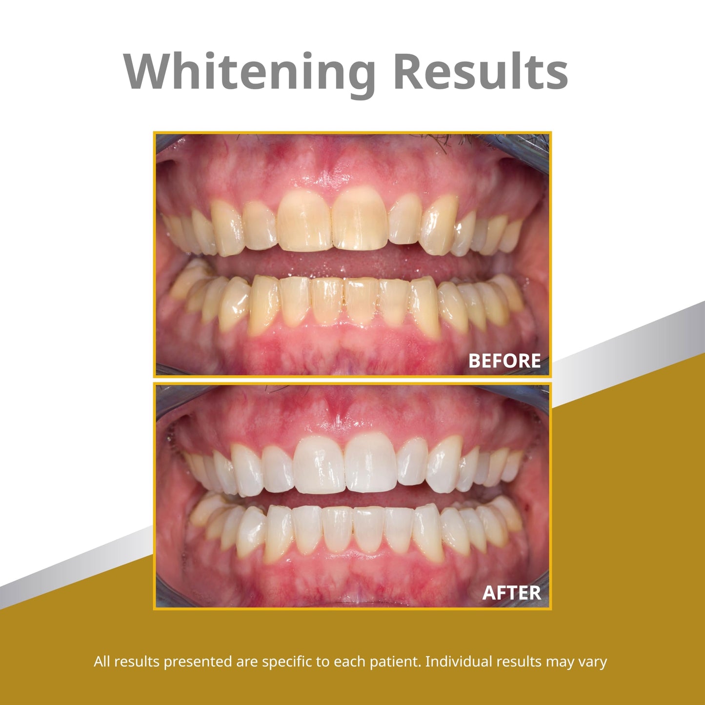 Opalescence 45% Whitening Gel – 4 Syringes Refill (Mint) | Ultradent PF