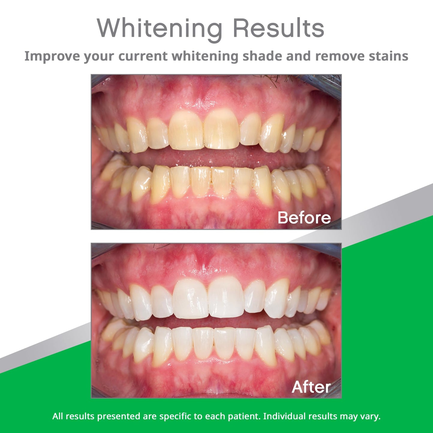 Opalescence Go 10% Prefilled Teeth Whitening Trays Kit – Mint | Ultradent
