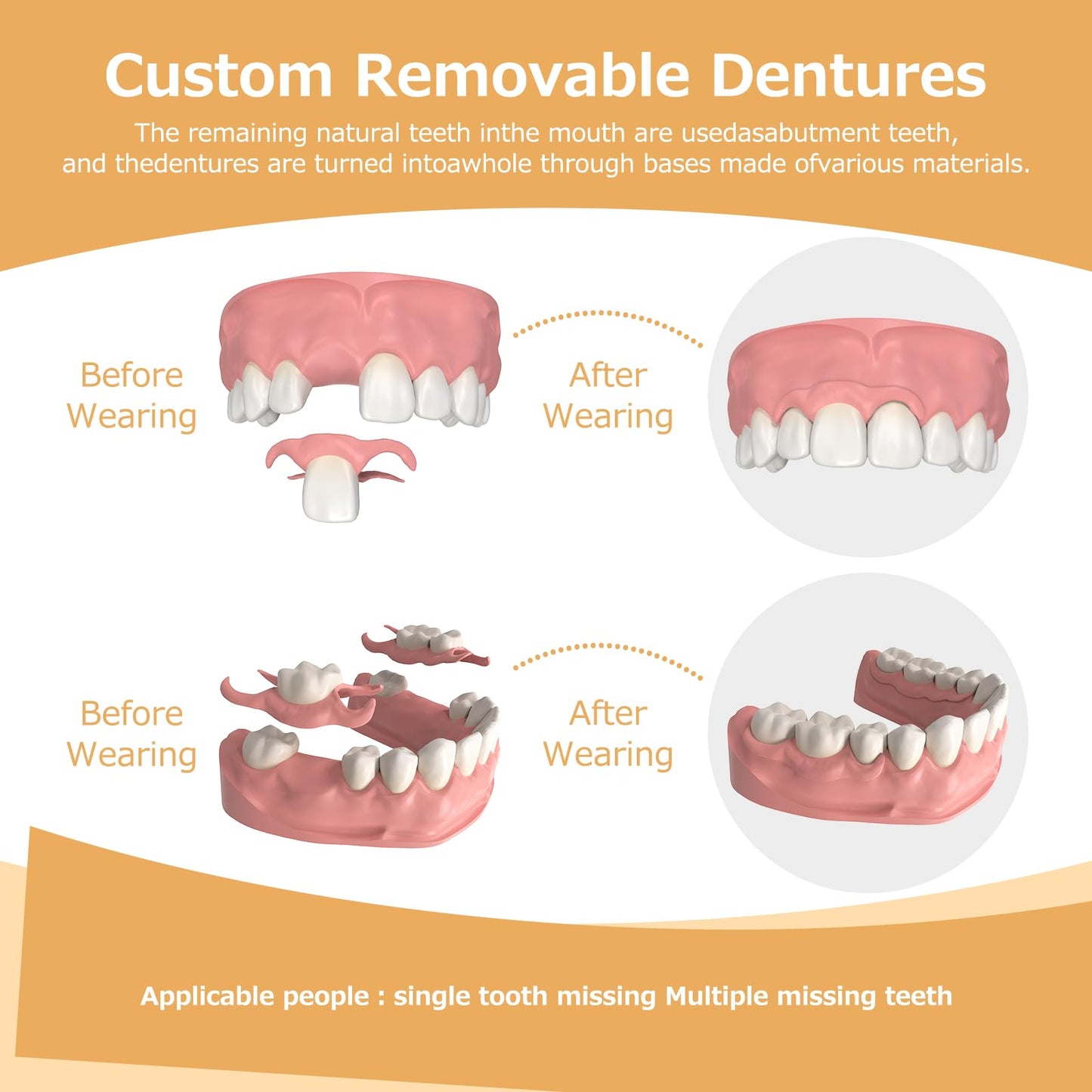 Partial Dentures for Missing Teeth & Gaps — Lightweight, Unbreakable Replacement Teeth (1 Tooth)