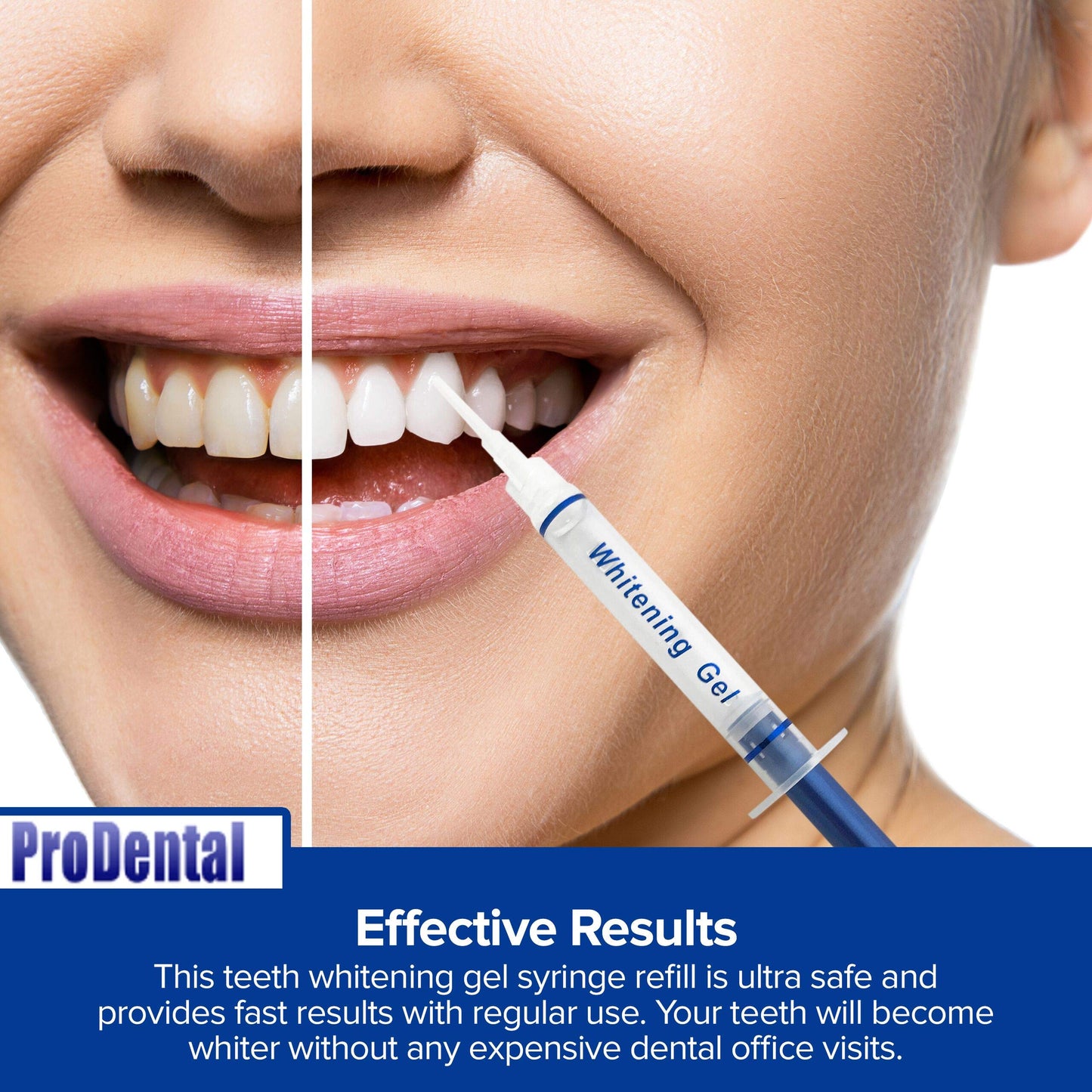 ProDental Teeth Whitening Gel Refill 8 Pack – 35% Carbamide Peroxide, 48 Treatments