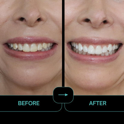 Prostrips: 12 Shades Whiter Teeth - Enamel-Safe Remineralizing Strips (No Sensitivity)