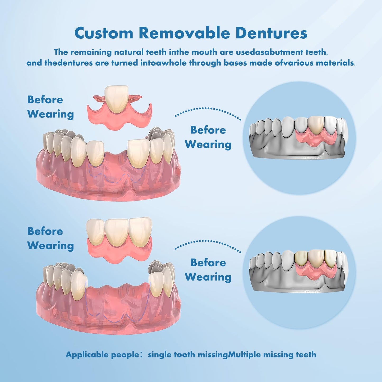 Custom Removable Dentures – Personalized Partial Dentures with Storage Case (1-6 Teeth)