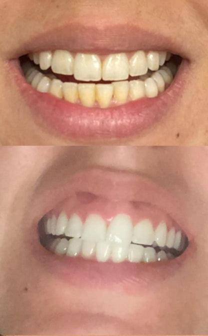 Smile Titan Whitening Gel Refill – 4x Syringes, 44% CP