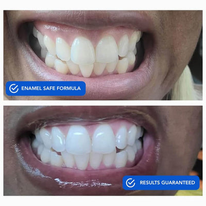 SNOW Diamond Dissolving Teeth Whitening Strips - Enamel Safe At-Home Whitening (42 Ct)