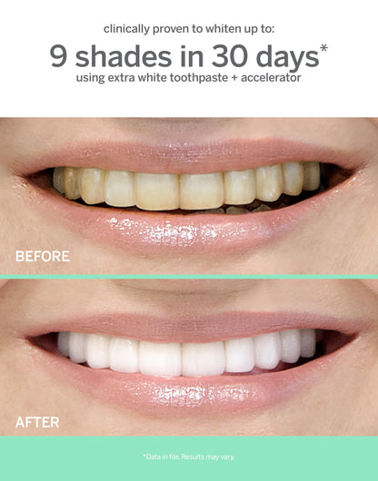 Supersmile Extra White Professional Whitening Accelerator – Enamel-Safe Teeth Whitening Gel, 7 oz