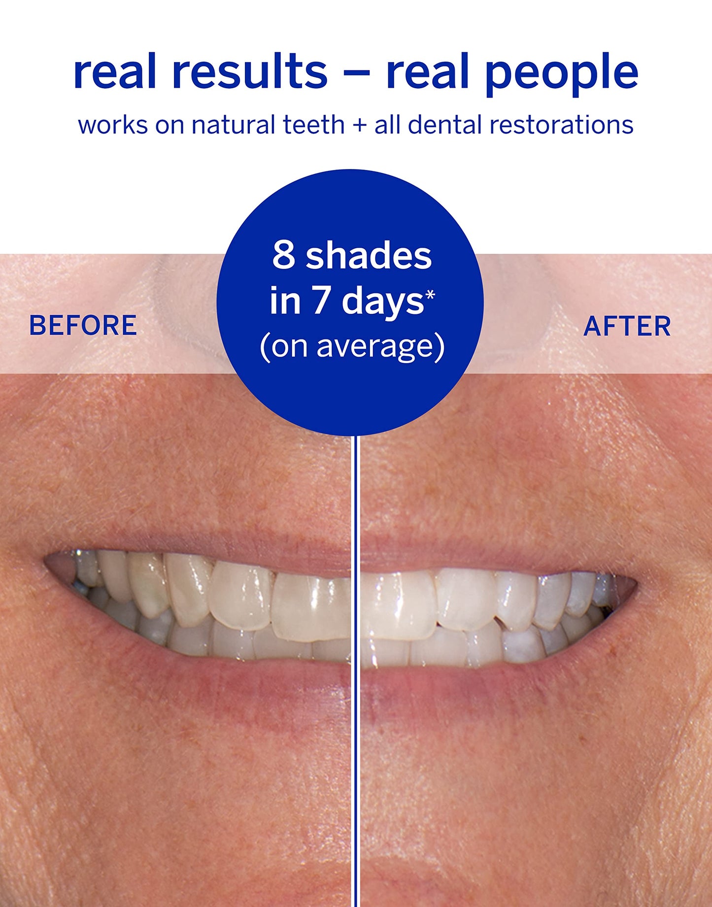 Whitening Strips by Supersmile – Superstrips for Sensitive Teeth, Enamel Safe