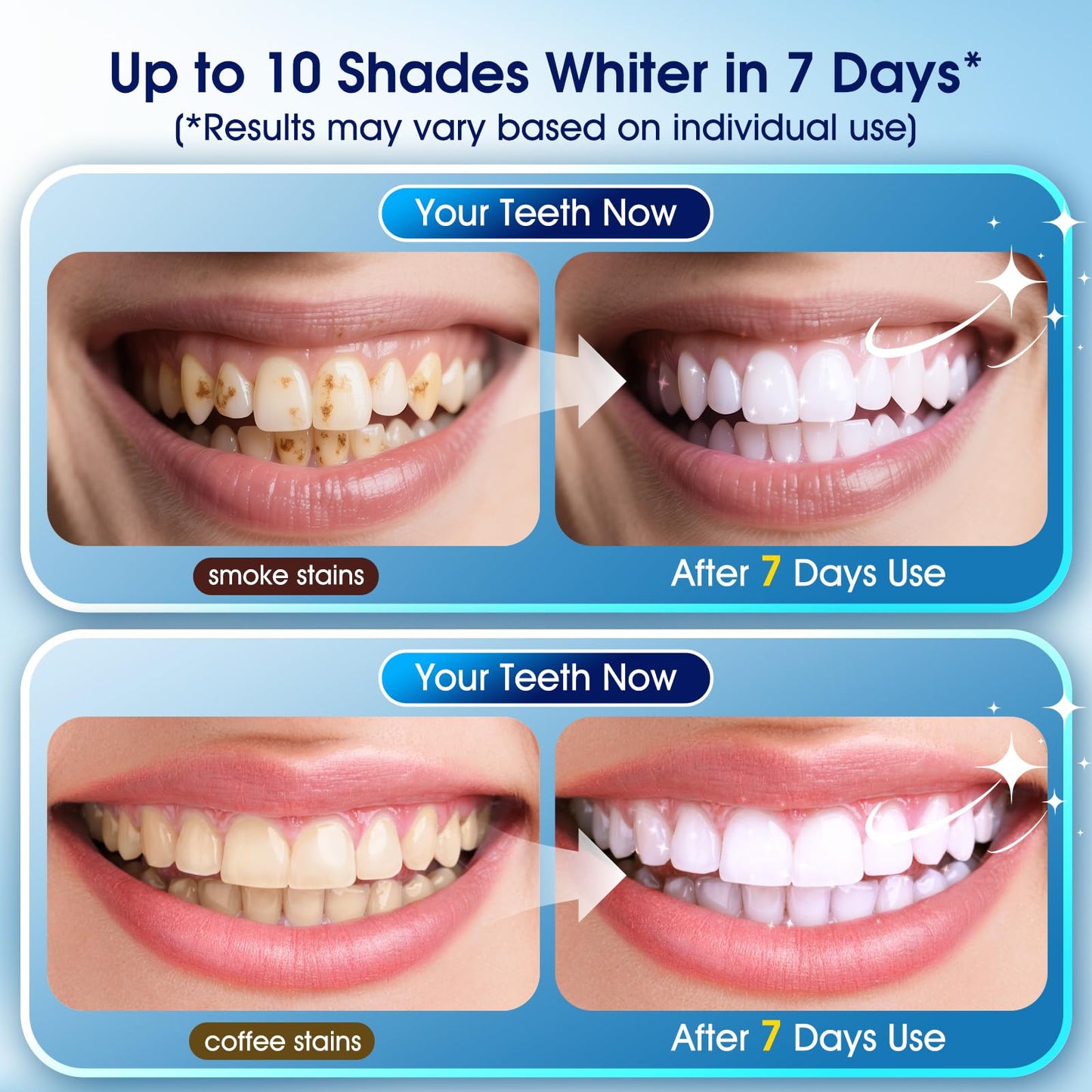 Teeth Whitening Kit – 3 Pens + 2 Desensitizing Pens | LED Light, 35% Carbamide Peroxide
