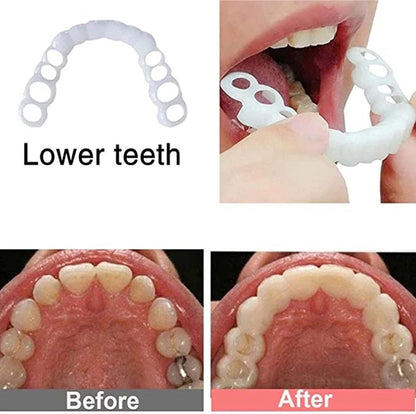 Temporary Adjustable Smile Support - 2 Pairs, Comfortable & Secure, Top & Bottom Included‌ (1)