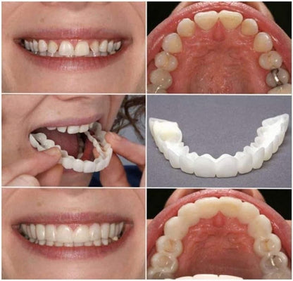 Temporary Adjustable Smile Support - 2 Pairs, Comfortable & Secure, Top & Bottom Included‌ (1)