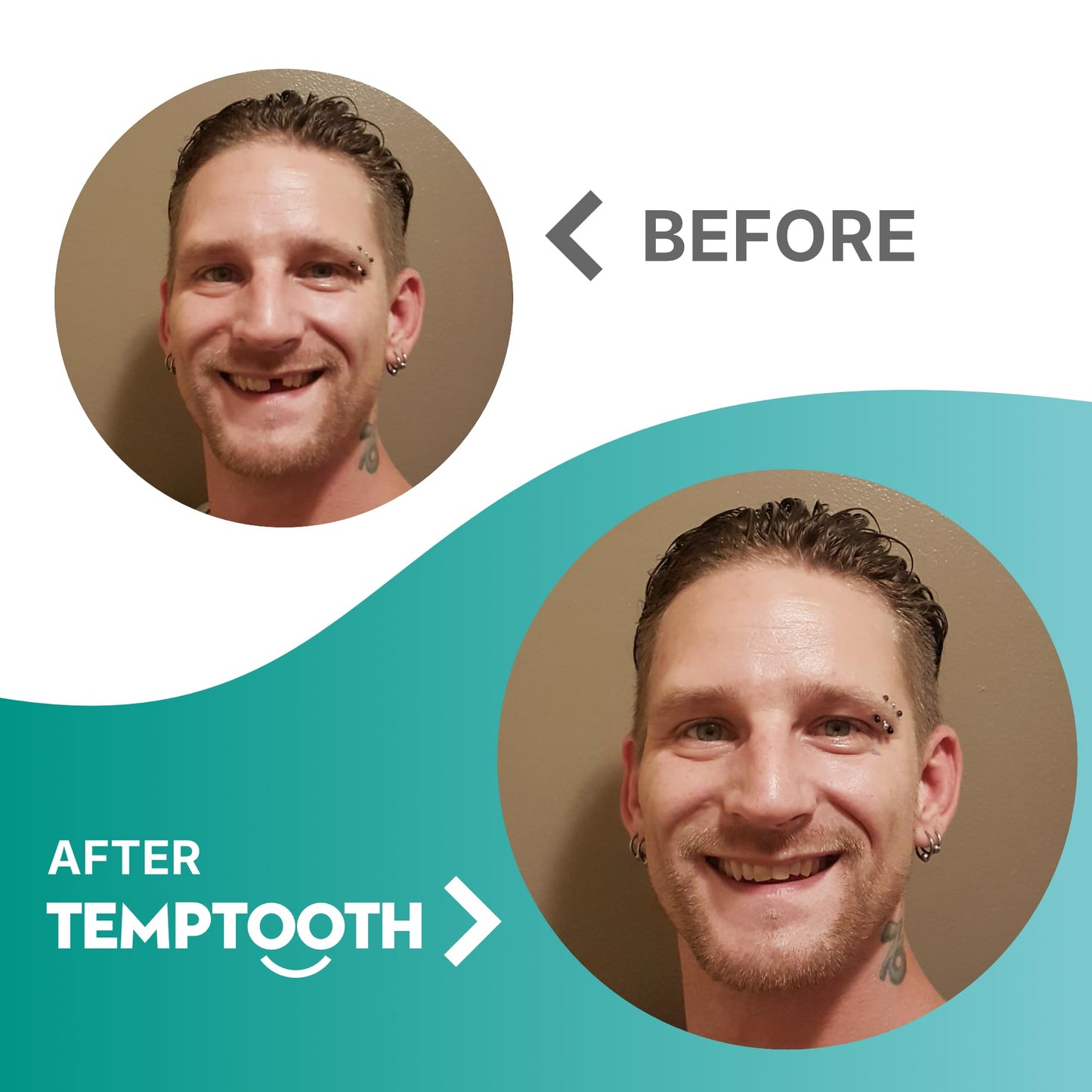 Temptooth Tooth Replacement Product with Coloring Material - Easy Shade Matching