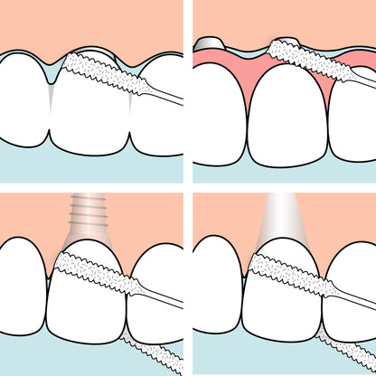 TePe Bridge & Implant Floss for Implants, Bridges & Braces – 30 Pieces