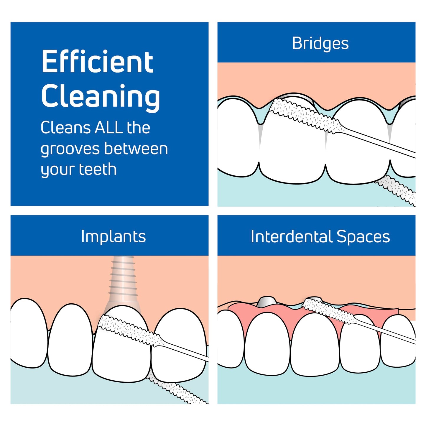 TePe Bridge & Implant Floss for Implants, Bridges & Braces – 30 Pieces (Pack of 2)