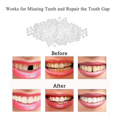 Tooth Repair Kit - Thermal Beads for Filling Gaps & Broken Teeth