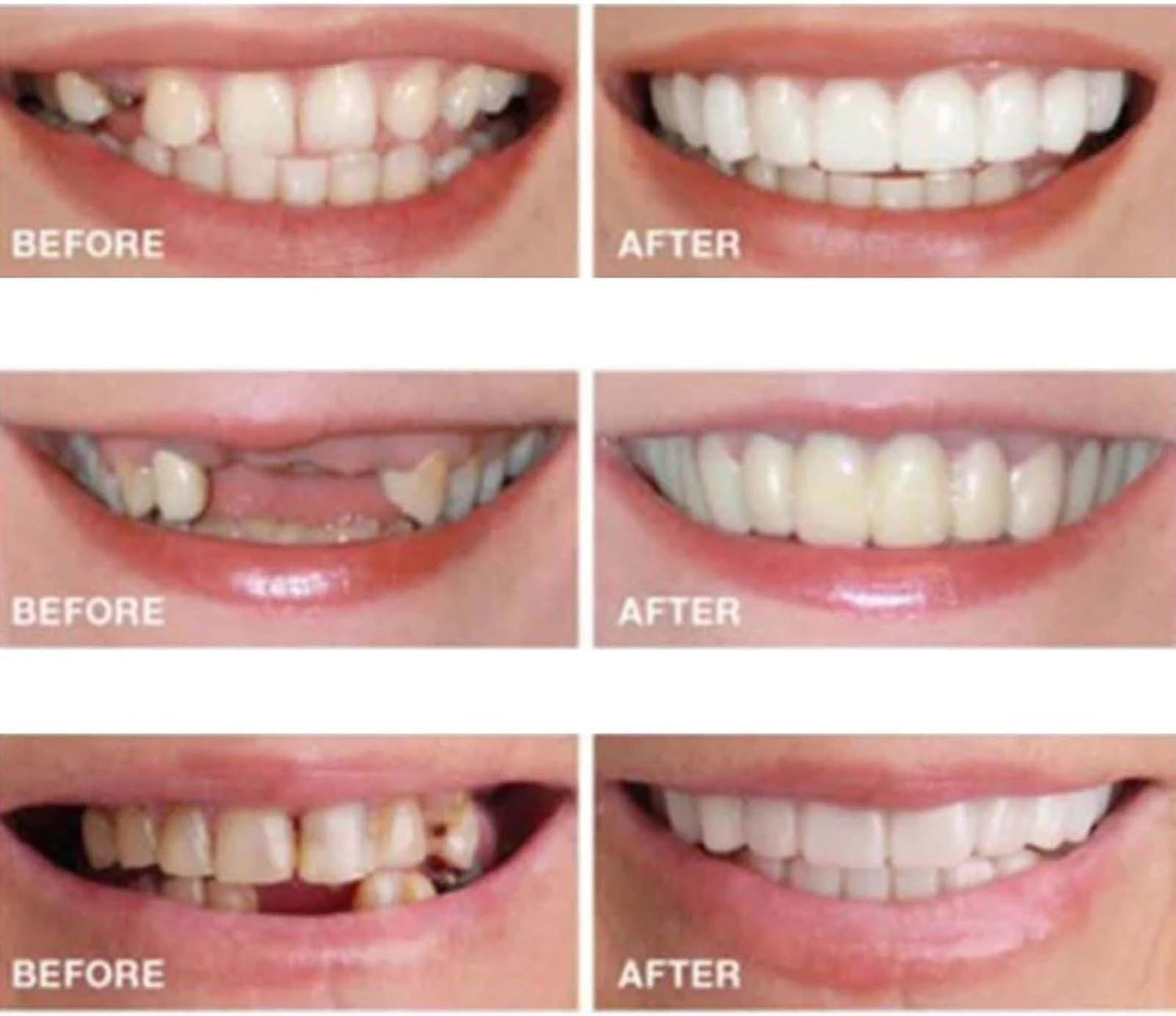 2 Pairs Temporarily Adjustable Smile Aligners – Natural & Comfortable for Men & Women (White)