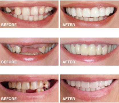 2 Pairs Temporarily Adjustable Smile Aligners – Natural & Comfortable for Men & Women (White)