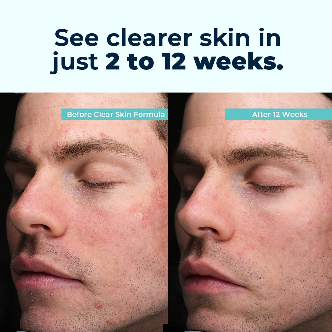 VitaMedica Clear Skin Vitamin Formula — Noncystic Acne Support (2 Pack)
