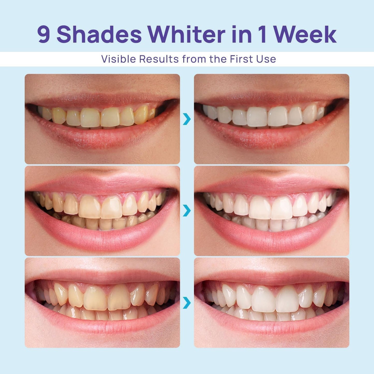 Whitebite Pro Teeth Whitening Kit for Sensitive Teeth – Dual LED, 35% Carbamide Peroxide Gel, Remineralizing Gel | At-Home Whitening